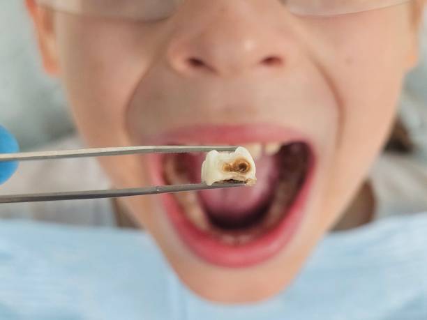 Best Urgent Care for Lost Fillings or Crowns in Vernon, WI